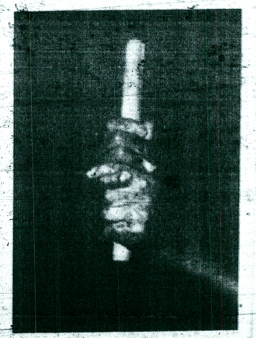 X-Ray of Alexander's interlocking grip.